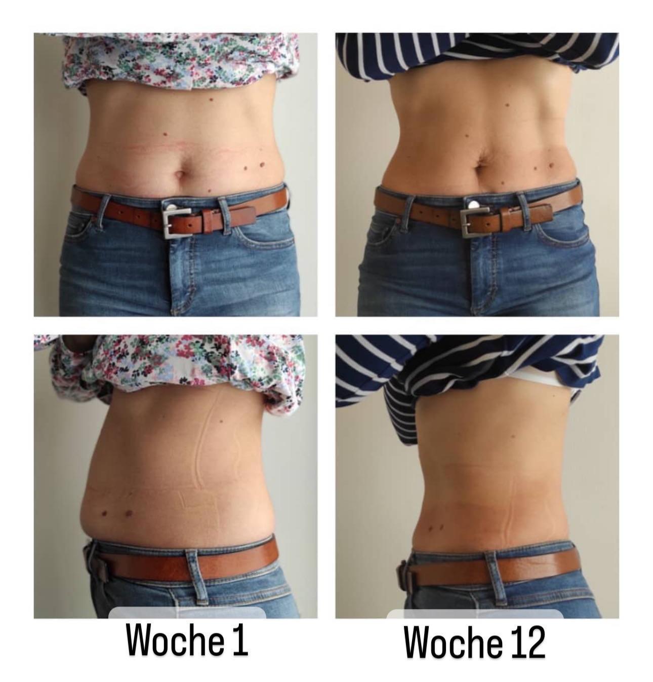 Vorher-Nachher: Frau nach Tupler-Technik® Programm. Schließung der Rektusdiastase, glatter Bauch von Woche 1 zu Woche 12.