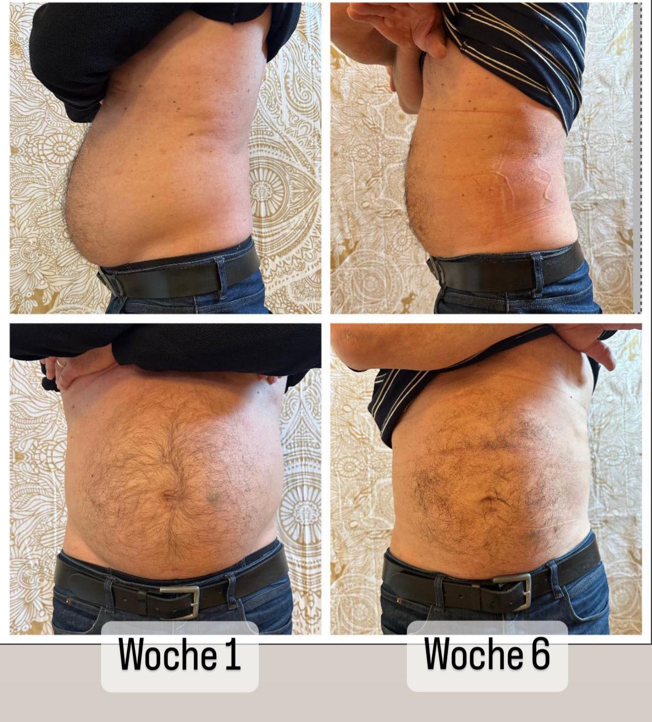 Vorher-Nachher: Mann nach Tupler-Technik® Programm. Sichtbare Reduktion der Bauchwölbung von Woche 1 zu Woche 6.